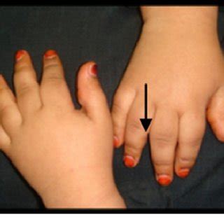stubby hands meaning